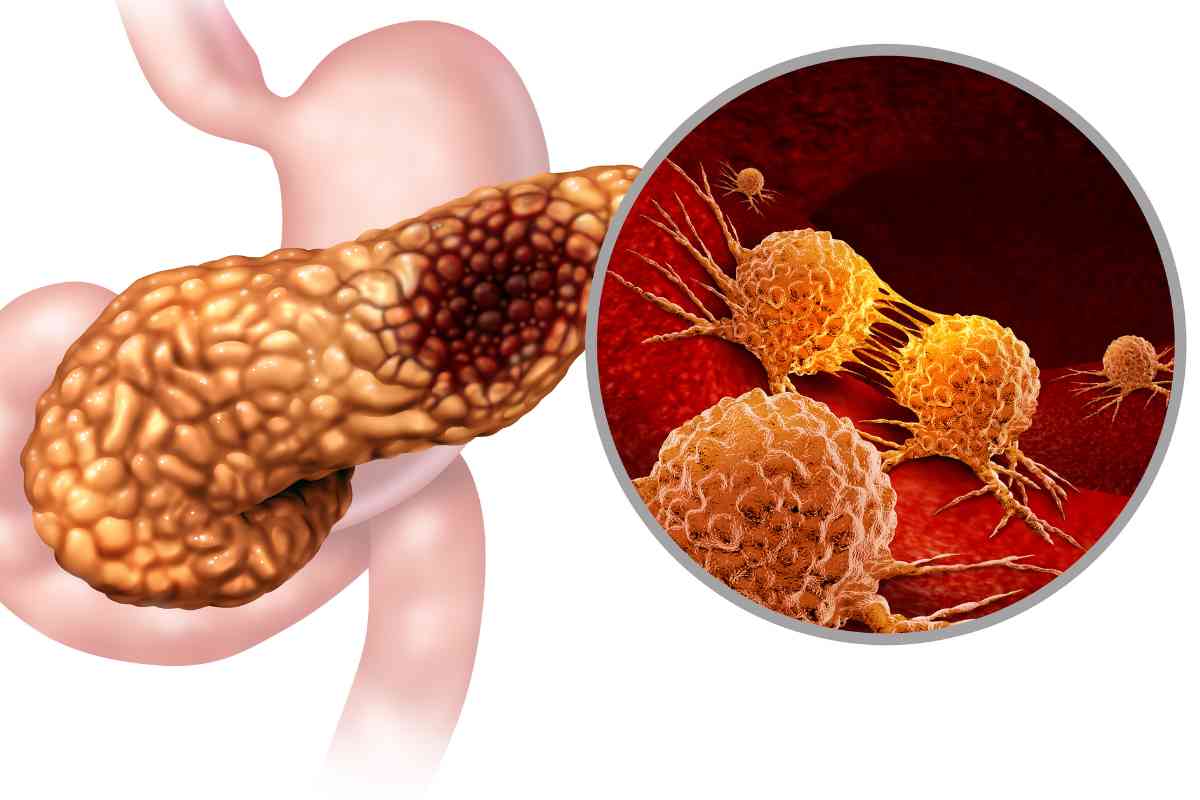 tumore al pancreas mastroianni